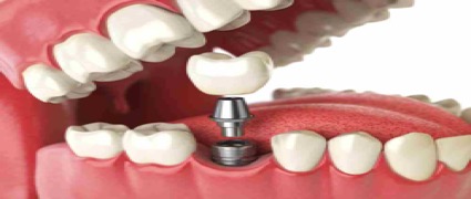 Las ventajas de un implante dental.